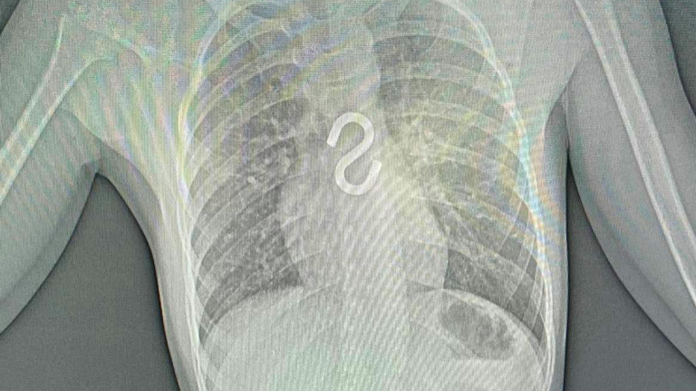 Иркутские врачи удалили строительный крючок из пищевода 8-летнего ребёнка