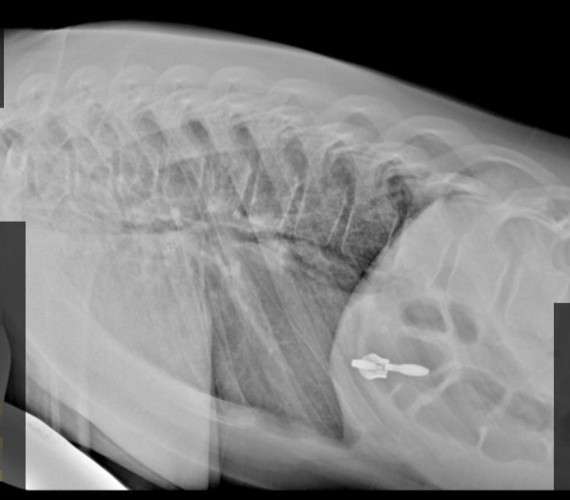 Пять детей с компрессионными переломами позвоночника попали в больницу Иркутска за сутки