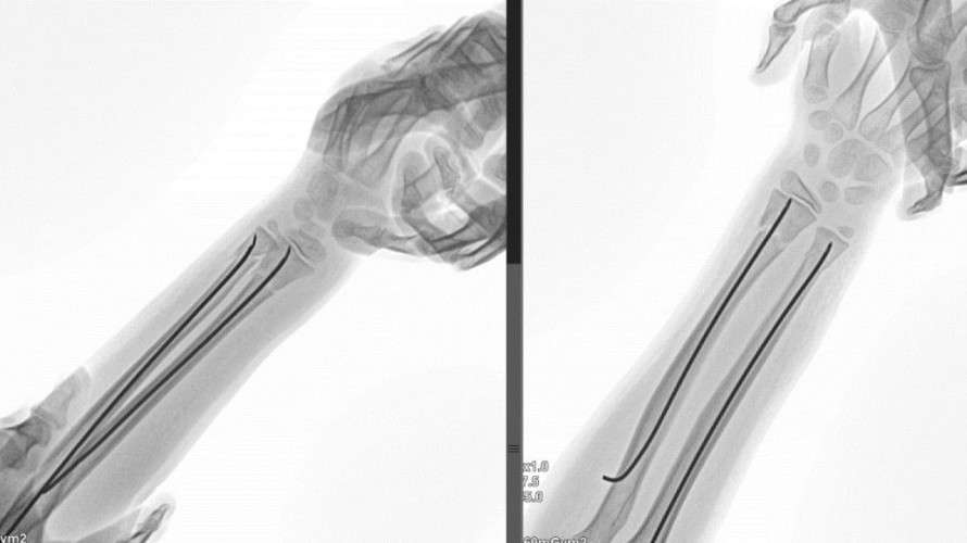 Ренгеновский снимок