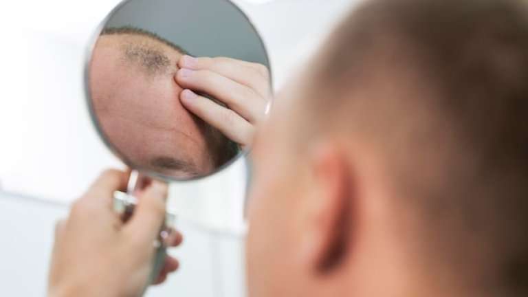 Алопеция: причины, симптомы, методы борьбы