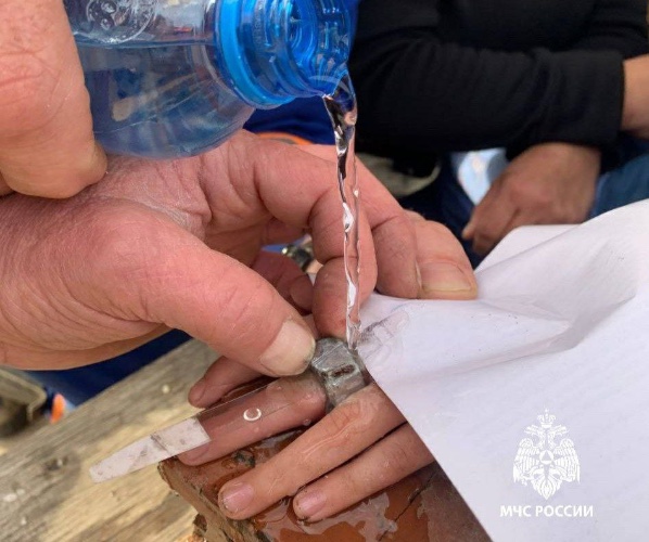 Гайку с пальца 10-летнего мальчика сняли спасатели в Иркутской области