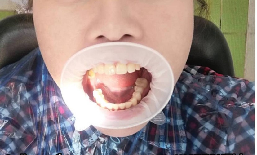 Имплантация зубов