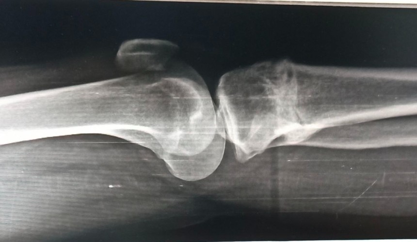 Выпуск нового материала для восстановления костей начали в Сибири