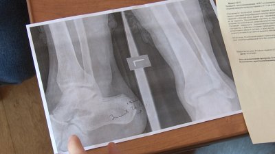 Медики не  сразу заметили два перелома ноги у жителя Иркутска